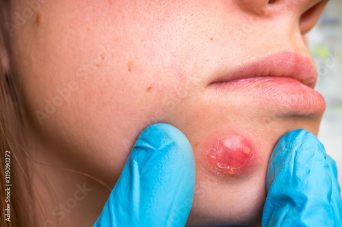 Bild auf Leinwand Woman with birthmark on her face, skin tags removal