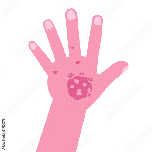 Hand with psoriasis or Eczema. Vector illustration.