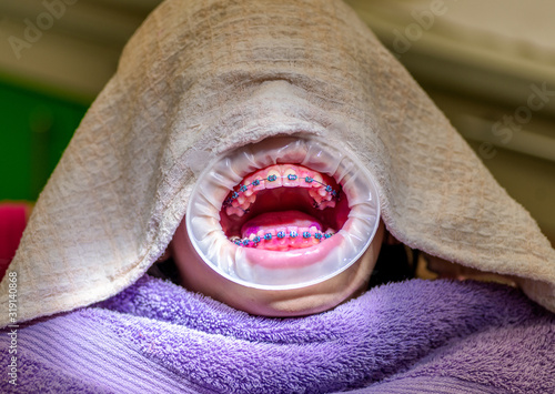 Bilde på lerret Patient with braces and a cheek retractor in a dental clinic