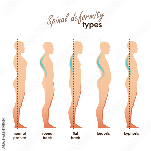 Spinal deformity types. Diseases of the spine.Lordosis, kyphosis, round back, flat back. Vector human silhouettes