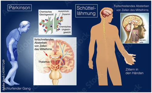 Parkinson. Schüttellähmung