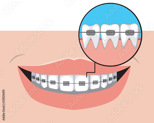 Metal braces with a smile as a treatment concept in a dental or orthodontic clinic, a vector stock illustration with problems with molars and incisors
