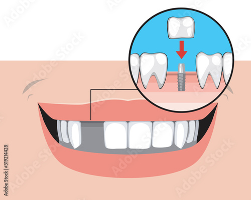 Missing tooth and implant on a pin with a smile as a treatment concept in a dental or orthodontic clinic, a vector stock illustration with problems with molars and incisors