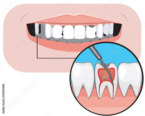 A caries and pulpitis with a smile as a treatment concept in a dental or orthodontic clinic, a vector stock illustration with breakdowns with molars and incisors