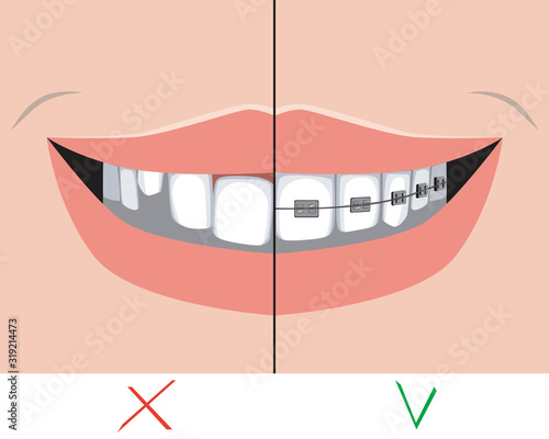 A metal braces and crooked teeth with a smile as a treatment concept in a dental or orthodontic clinic, a vector stock illustration with problems with molars and incisors before and after treatment