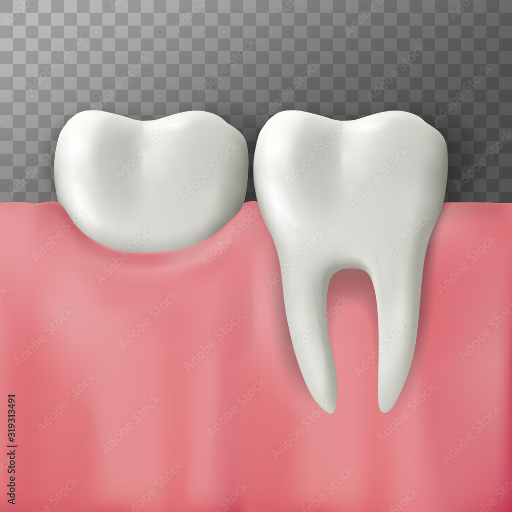 Realistic Vector illustration of teeth on gum. Transparent background. Realistic Vector illustration of teeth on gum. Transparent background.