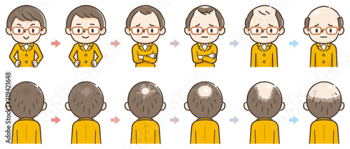 薄毛の進行　ハゲ