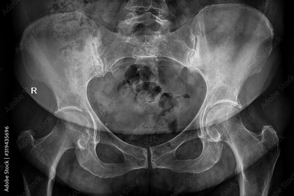 Radiography X Ray Film Of Human Pelvis Stock Photo Adobe Stock