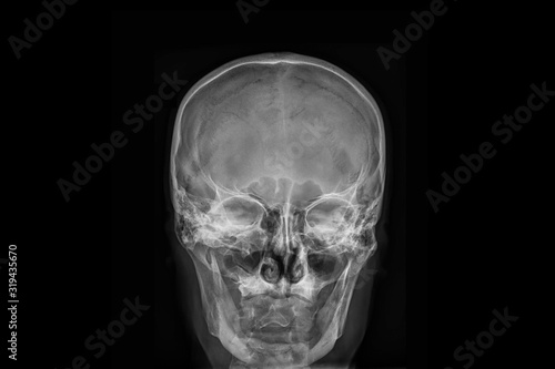 Radiography x-ray film of human skull photo
