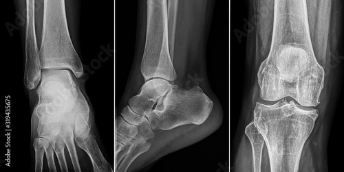  x-ray film of human foot and knee