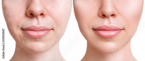 Face of beautiful woman before and after acne treatment and retouch.
