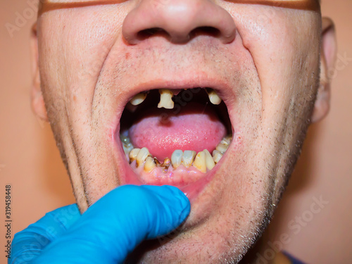 Diseased teeth. Severe rot, caries, tooth loss. A man examined by a dentist before treatment, restoration and prosthetics.