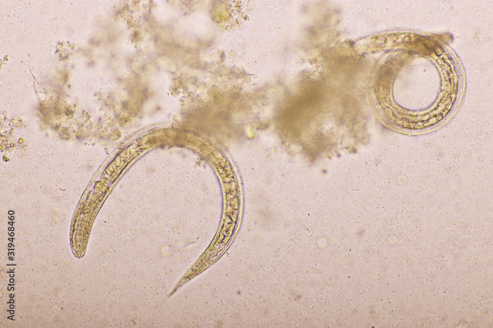 Strongyloides stercoralis or threadworm in human stool, analyze by ...