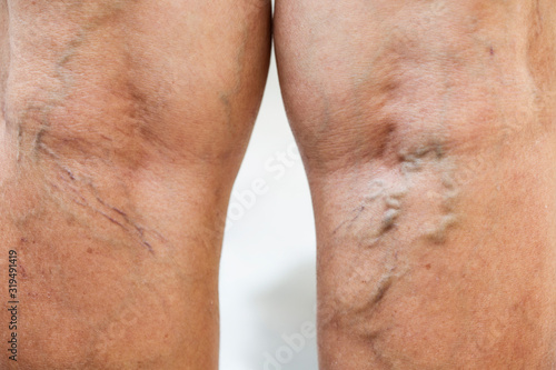 Photography Painful varicose and spider veins on womans legs ,active life concept