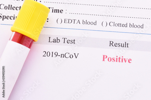 Positive test result of coronavirus 2019 or 2019-nCoV, novel coronavirus found in Wuhan, China