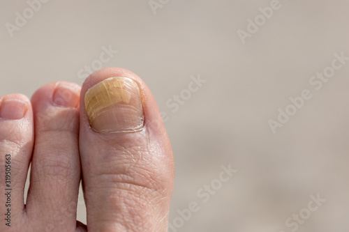 A close up of a toe with fungal infection or psoriasis with a light background.