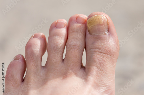A close up of a toenail with fungal infection or psoriasis with a light background.