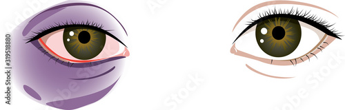 Human eyes, one of them bruised, EPS 8 vector illustration, no transparencies