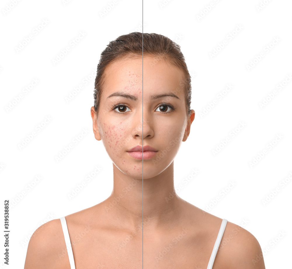 Teenage girl before and after acne treatment on white background Stock ...