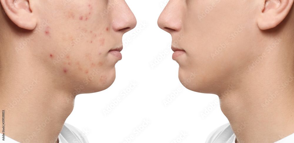 Teenager before and after acne treatment on white background, closeup Teenager before and after acne treatment on white background, closeup