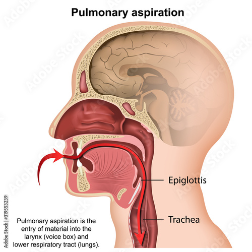 pulmonary aspiration medical vector illustration isolated on white background