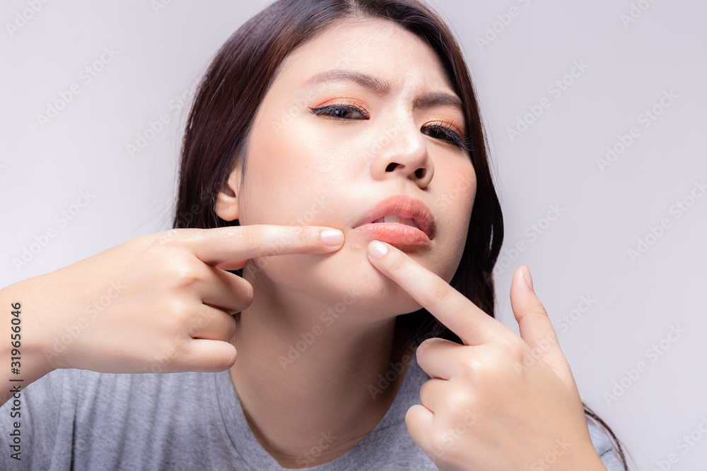 Asian woman is squeezing acne or pimple often on her beautiful face or chin by her index fingers that makes her get ugly scar on face. before she get Menstruation, pimple will appear on her chin Asian woman is squeezing acne or pimple often on her beautiful face or chin by her index fingers that makes her get ugly scar on face. before she get Menstruation, pimple will appear on her chin
