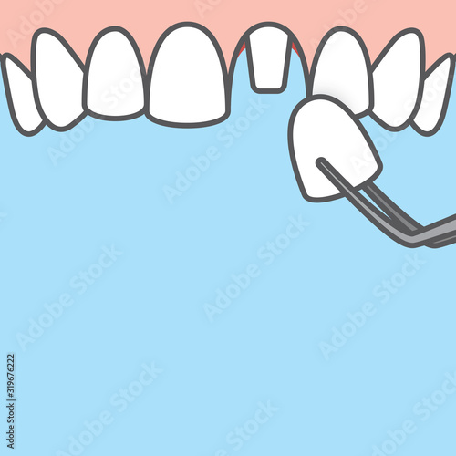 Blank banner Upper Single crown tooth illustration vector on blue background. Dental concept.