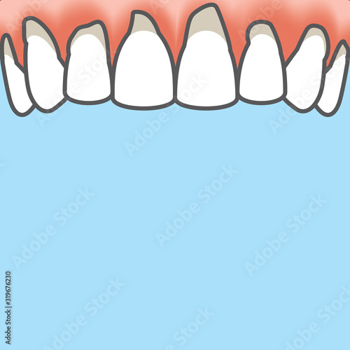 Blank banner Upper Periodontitis human gum inflammation illustration vector on blue background. Dental concept.