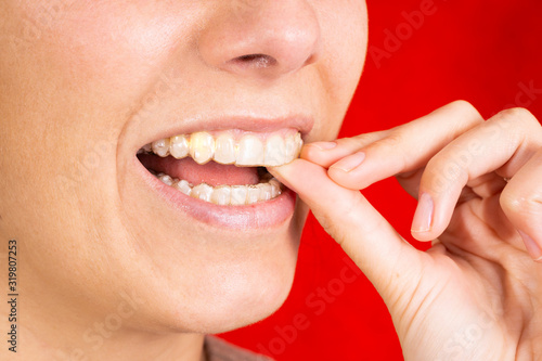 beautiful brunette woman with invisible brackets in her hand and smiling at the camera  dental concept  healthy and perfect smile on red background