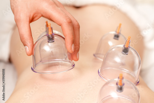 Vacuum cups of medical cupping therapy on woman back, close up, chinese medicine. photo
