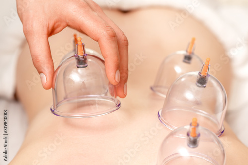 Vacuum cups of medical cupping therapy on woman back, close up, chinese medicine.