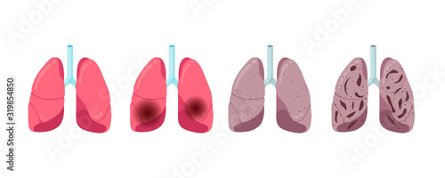 Lung diseases progression set. Healthy inflammation pneumonia and tuberculosis viral infection. Human respiratory system internal organ virus struck. Medical anatomy damage vector illusrtation