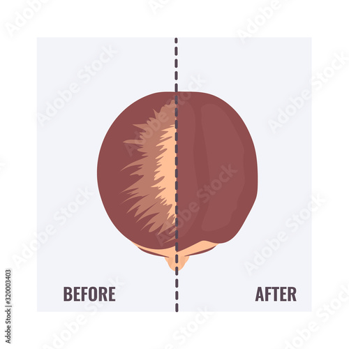 Top view portrait of a woman before and after hair treatment and transplantation. Divided image of a female head with alopecia and restored hairline. Two halves. Beauty concept. Vector illustration.