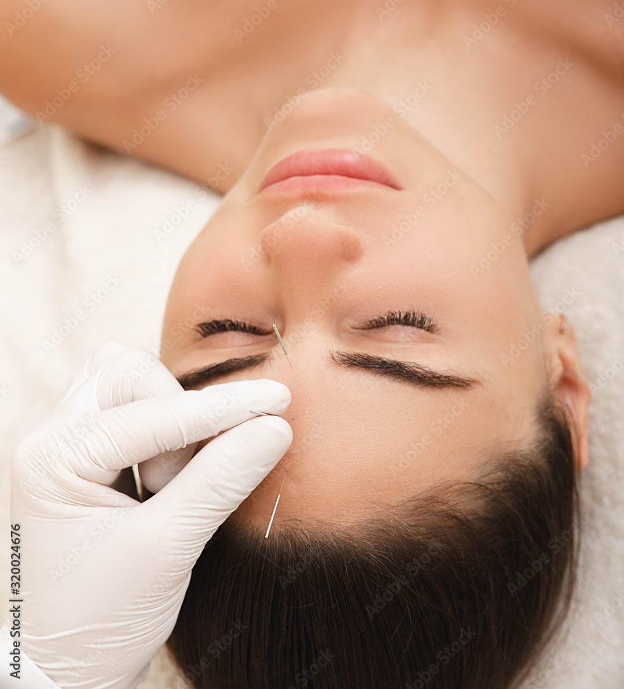 Acupuncture treatment for woman headache and migraine. Certified acupuncturist treats a woman's migraines with needles Acupuncture treatment for woman headache and migraine. Certified acupuncturist treats a woman's migraines with needles