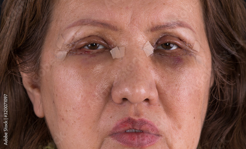 Eyes of an old woman after plastic surgery,blepharoplasty,eye bag removal