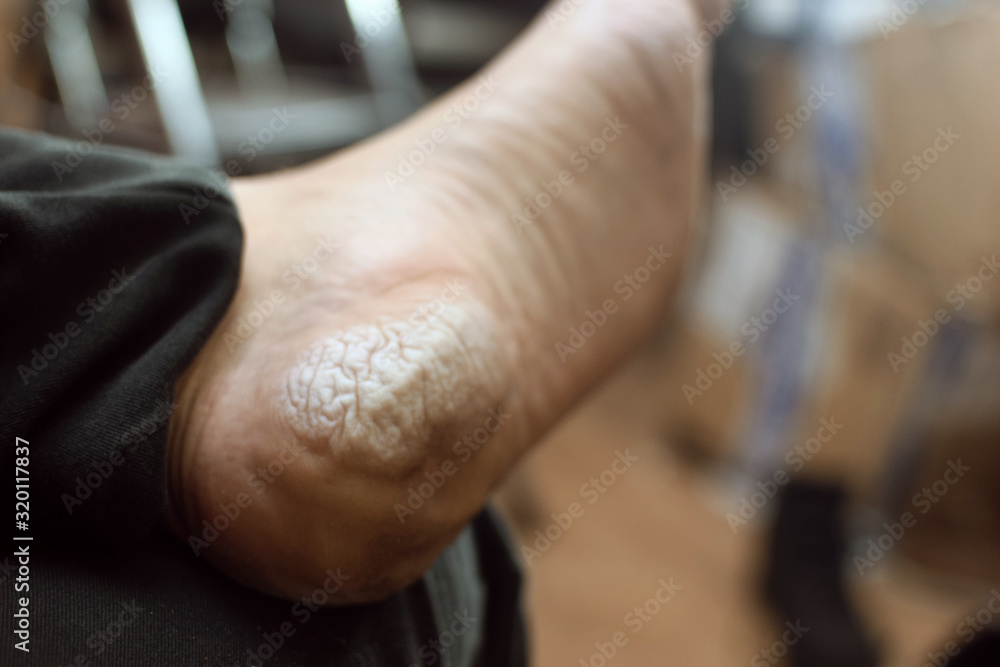 Dermatitis, sweating of the skin of the feet of a man due to bad shoes.