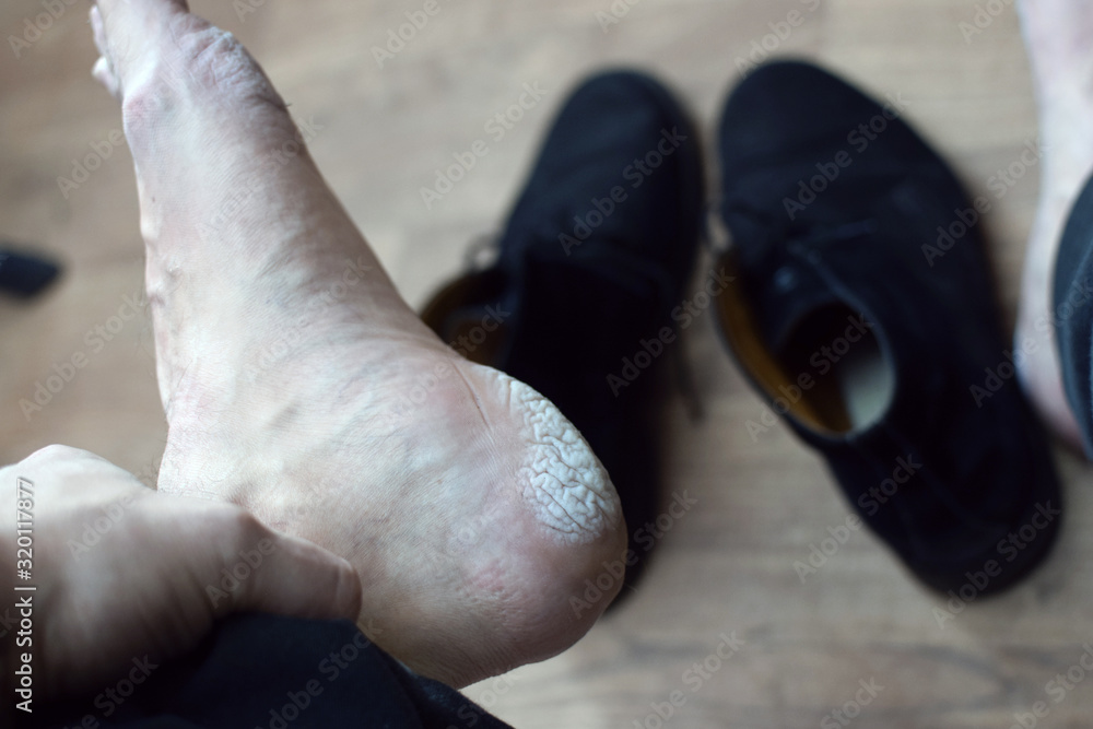 Dermatitis, sweating of the skin of the feet of a man due to bad shoes