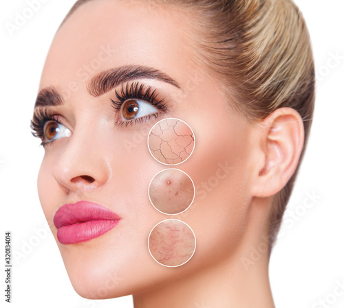 Small circles demonstrate couperose and acne on female face skin.