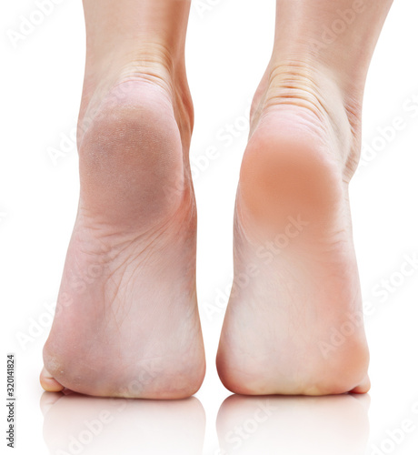 Female feet with dry skin before and after treatment or retouch.