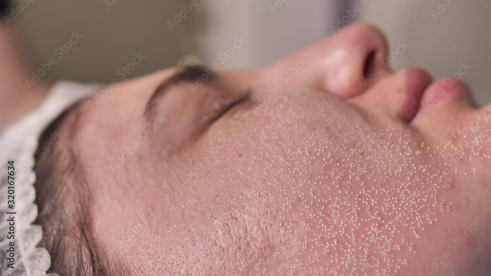 Resurfacing facial skin with a laser. CO2 laser face polishing in a cosmetology or plastic