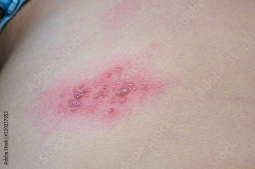 blisters caused by shingles on skin, herpes zoster