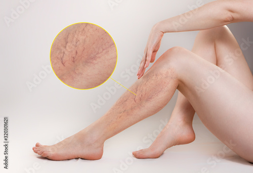 The concept of varicose disease and cosmetology. The woman sits gracefully setting aside her legs with vascular stars, and runs her palm over the skin. The enlarged image of blood vessels. Copy space