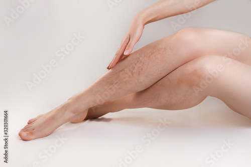 The concept of varicose disease and cosmetology. The woman gracefully crosses her legs with vascular stars, runs her hand over them. Copy space photo