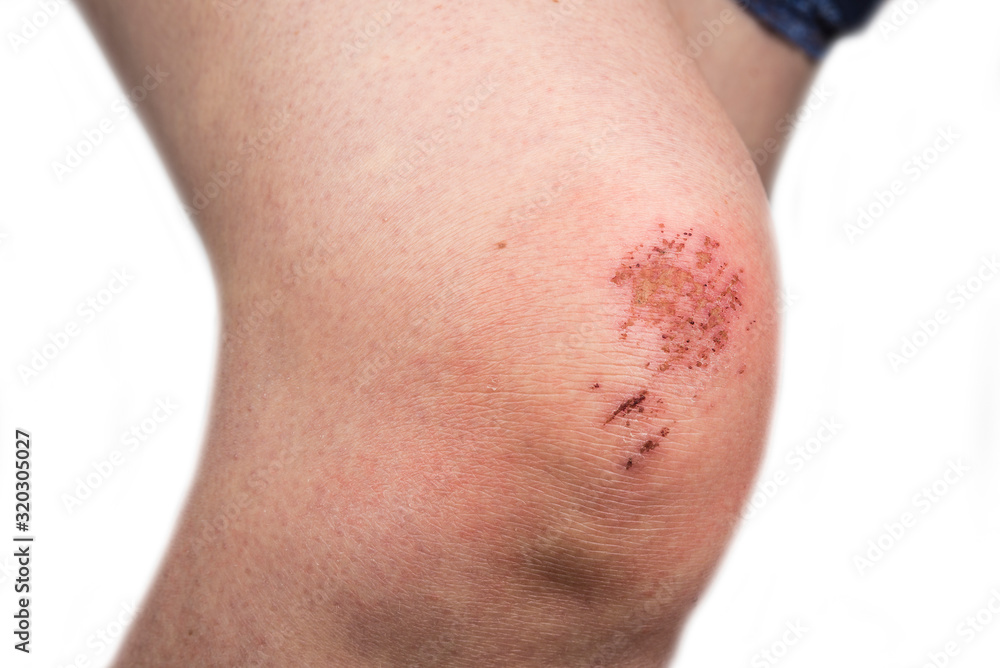 Woman scratch skin on the knee. Injury concept Woman scratch skin on the knee. Injury concept