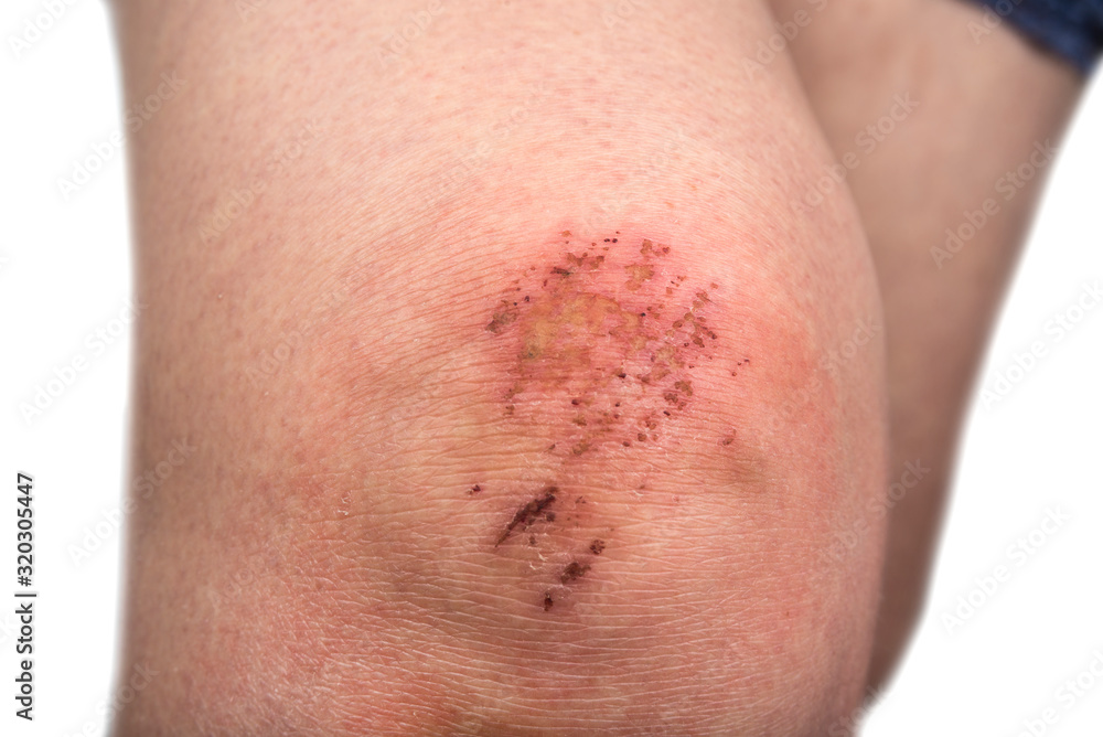 Fototapeta premium Woman scratch skin on the knee. Injury concept