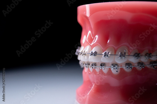 Close-up of teeth with metal braces. The jaw with braces turns on the surface.