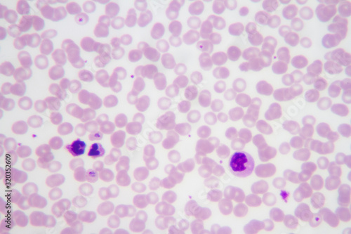Wall Mural Blood smear with the malaria parasite Plasmodium vivax.