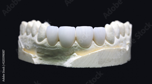 Dental crowns. Zirconium crowns on a black background photo