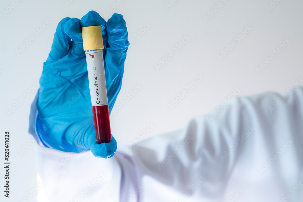 A positive blood test result for the new rapidly spreading Coronavirus, originating in Wuhan, China A positive blood test result for the new rapidly spreading Coronavirus, originating in Wuhan, China