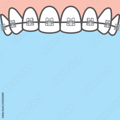 Blank banner Upper clear braces teeth illustration vector on blue background. Dental concept.
